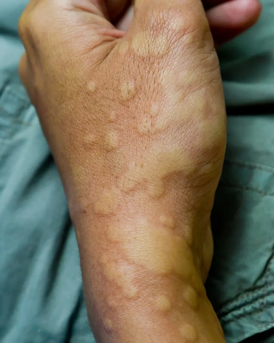 Advanced Urticaria Care at Cinch Clinics